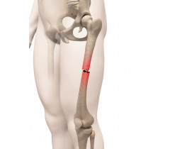 HOMEO : Les fractures correspondent à des cassures du tissu osseux ou des lésions osseuses consécutives à un traumatisme ou à une pathologie.